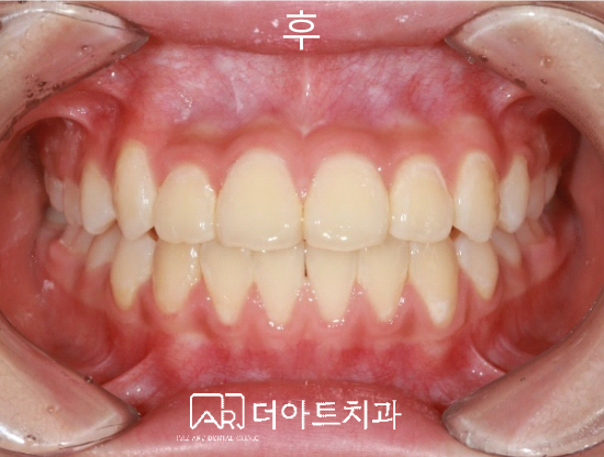 페이스마스크 치료 후