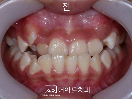 페이스마스크 치료 전