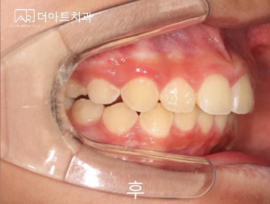 트윈블락 치료 후
