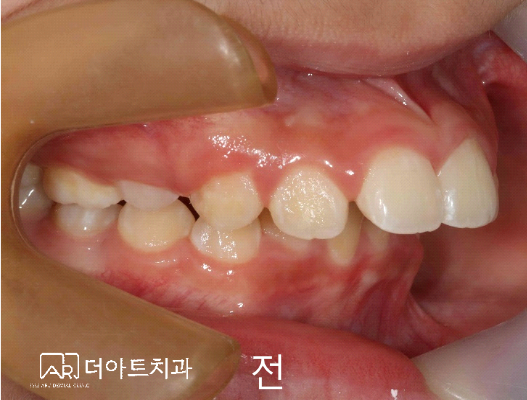 트윈블락 치료 전