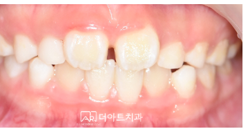 프리올소 치료 후 (정면)