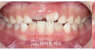 프리올소 치료 전 (정면)