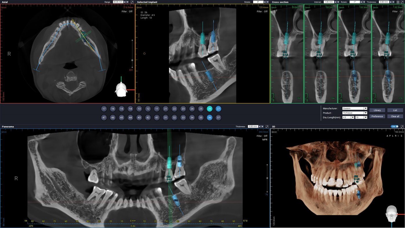 3D CT 수술 계획